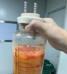 琼中水动力吸脂手术要做多久？